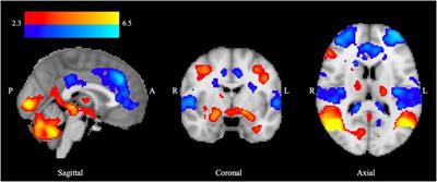 Selective D3 receptor antagonism modulates neural response during negative emotional processing in substance dependence